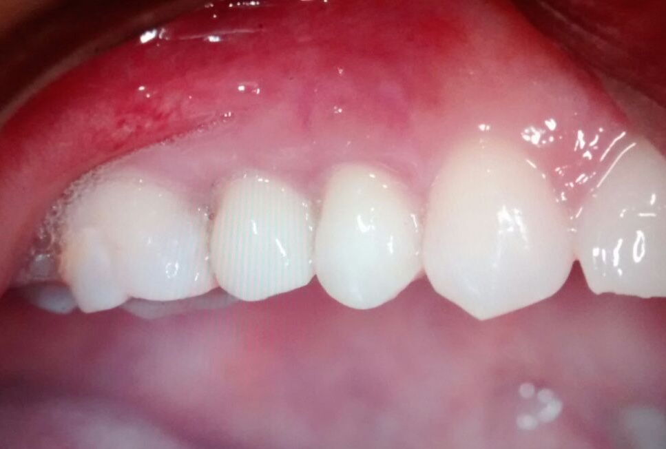 Implantes dentales Od Cozzarin CASO 1 (2)