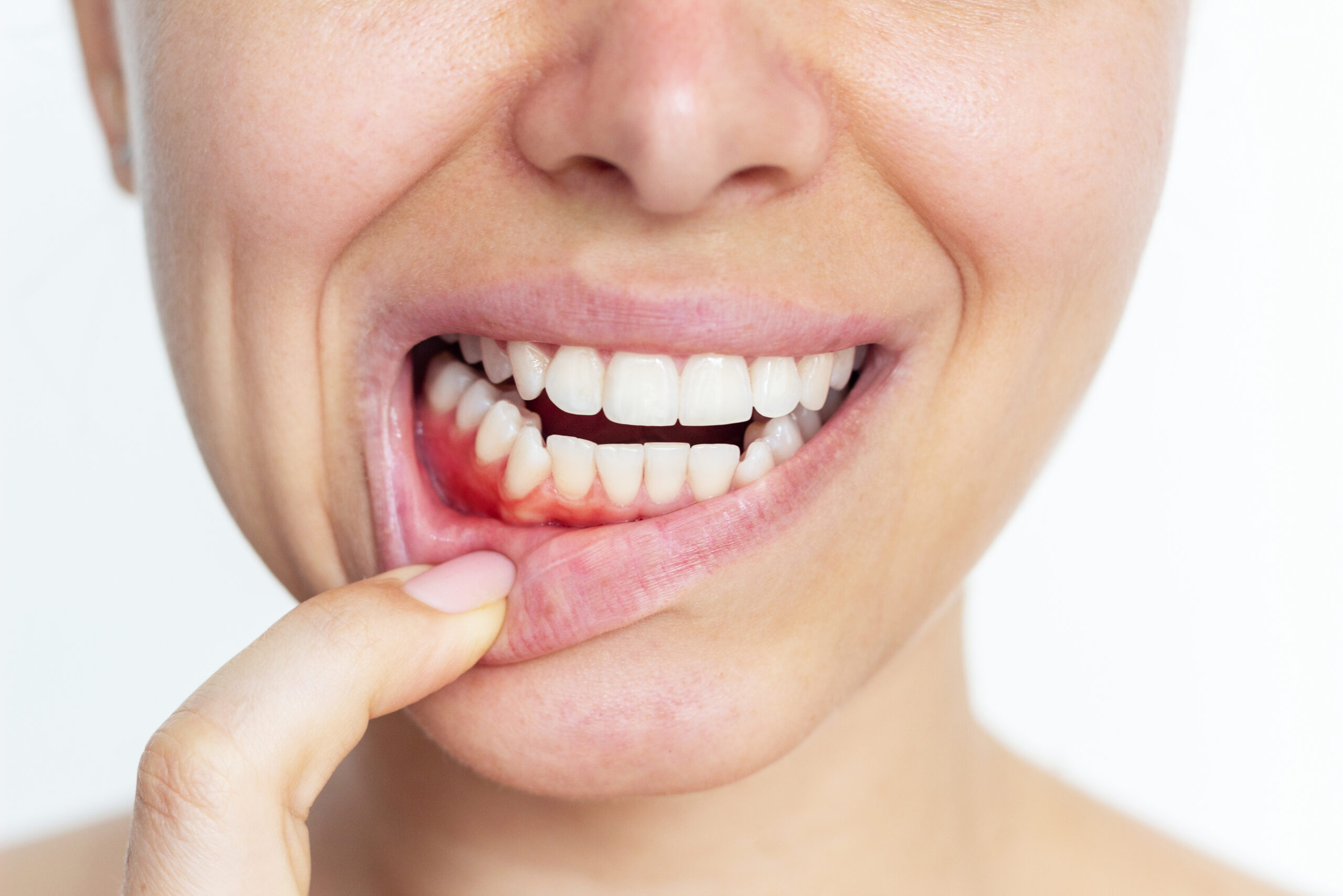 GINGIVITIS. Cuando el cepillado dental genera sangrado