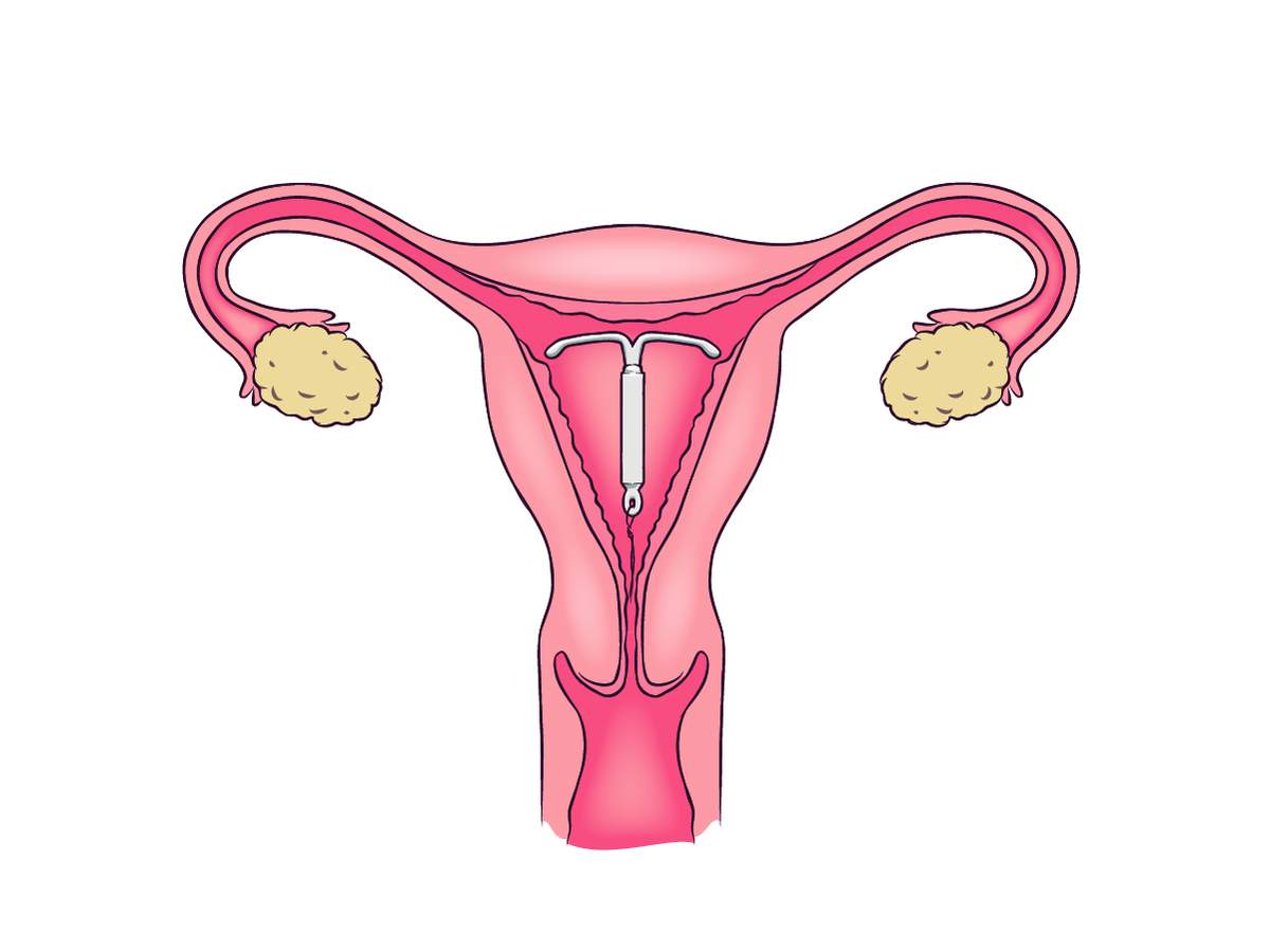 Los dispositivos Intrauterinos (DIU): lo que tenés que saber acerca de ellos