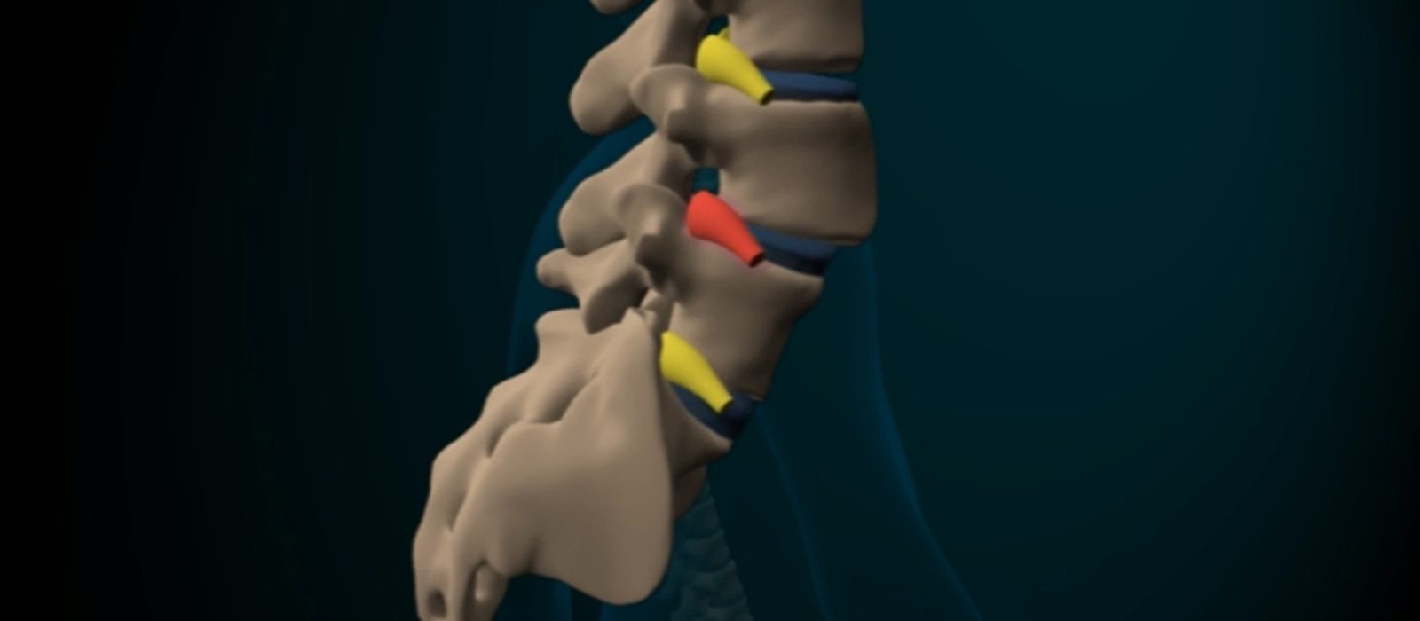 Espondilolistesis: En qué consiste?