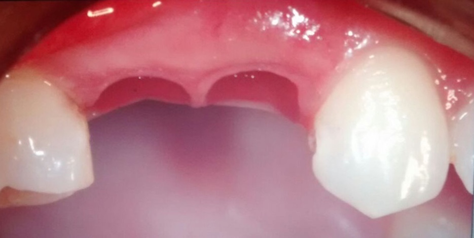 Implantes dentales Od Cozzarin CASO 1 (3)
