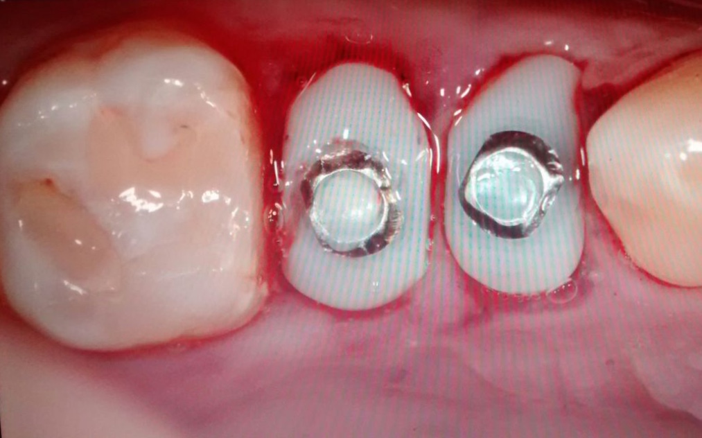 Implantes dentales Od Cozzarin CASO 1 (4)